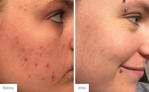 Acne Real Results Image 8